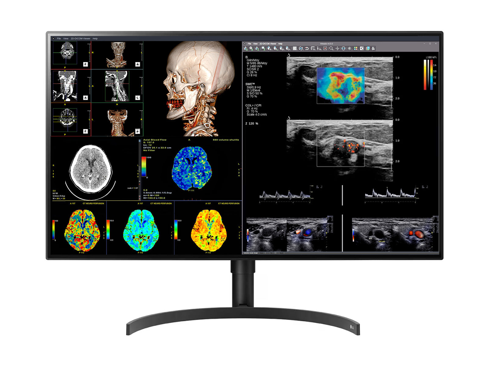 LG 8MP Fusion 4K 32" Color Medical Diagnostic Radiology Monitor 450 cd/m² DICOM Brightness (32HL512D)
