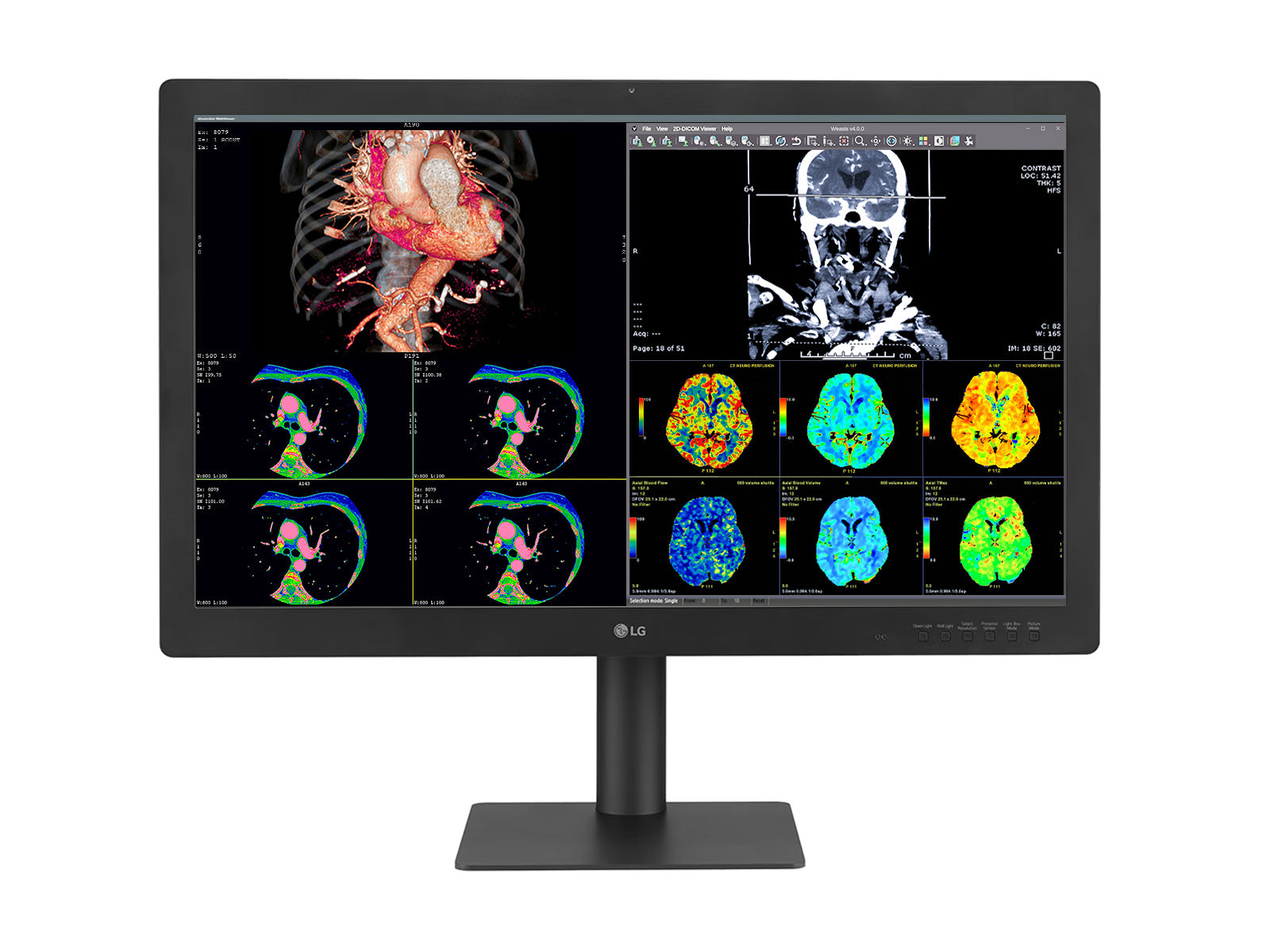 LG 32HQ713D 8MP 32" Diagnostic Fusion Color Medical Radiology PACS Monitor - 1000 cd/m² DICOM Brightness