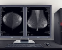 7 consideraciones al elegir una pantalla de mamografía