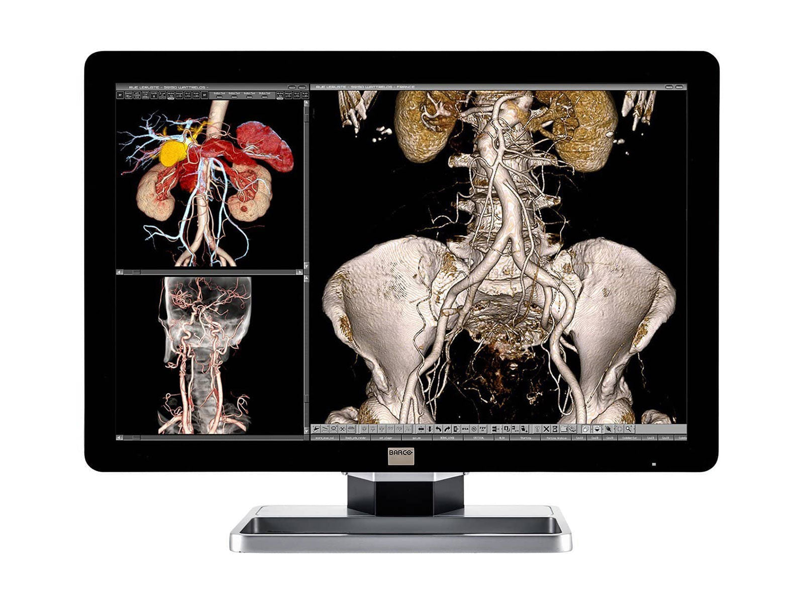 Barco® Coronis Fusion MDCC-6230 Écran PACS de radiologie générale à LED couleur 6MP 30.4" (K9601450)