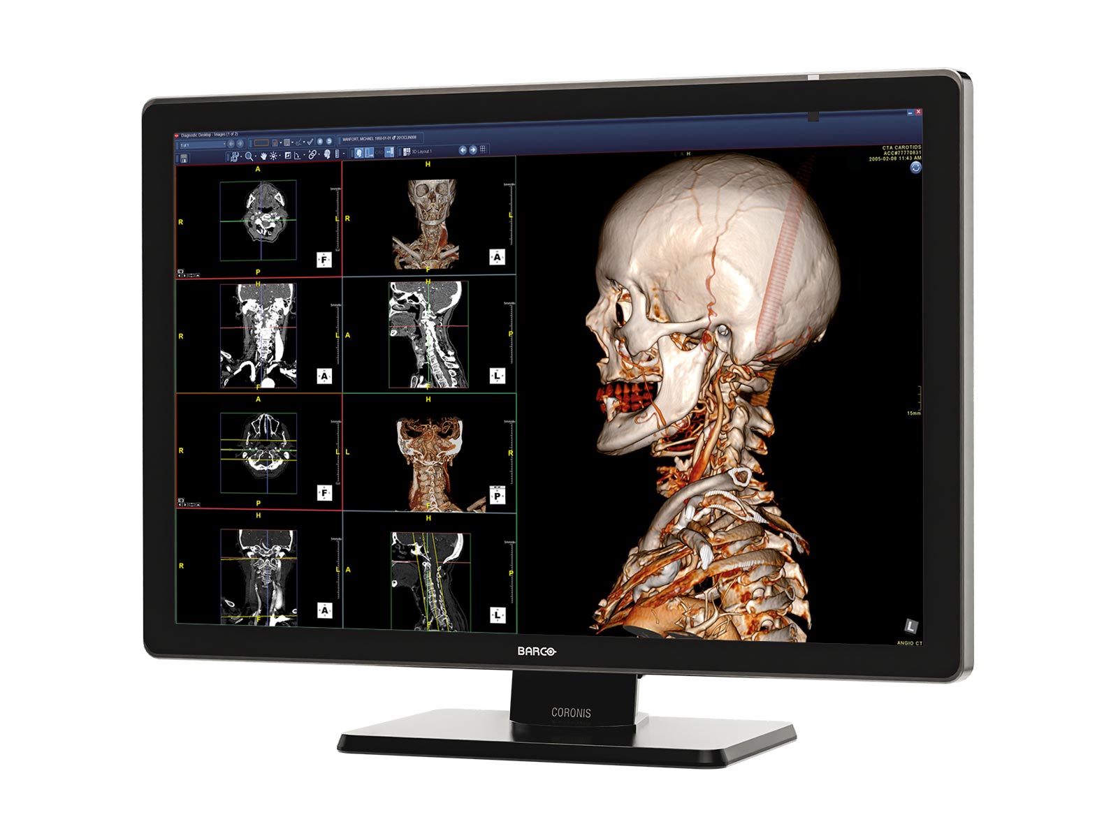 Barco Coronis Fusion MDCC-6530 Monitor de radiología de diagnóstico médico en color de 6MP y 30"