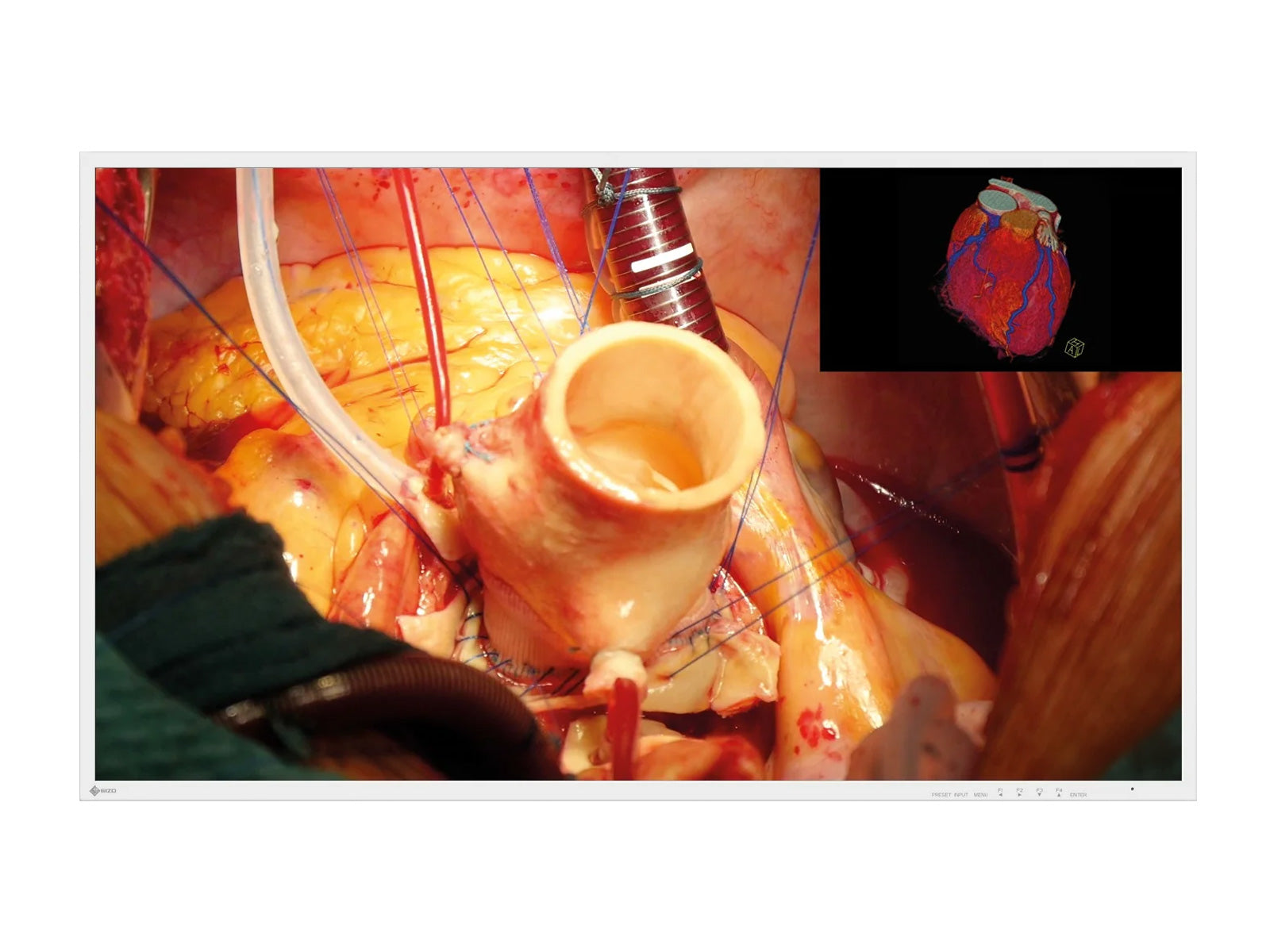 Eizo 43" 4K UHD Surgical Display Monitor (EX4342)