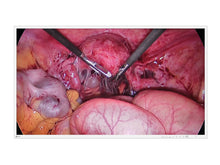 Eizo 43" 4K Monitor Médico de Endoscopia Quirúrgica 3D UHD (EX4342-3D)