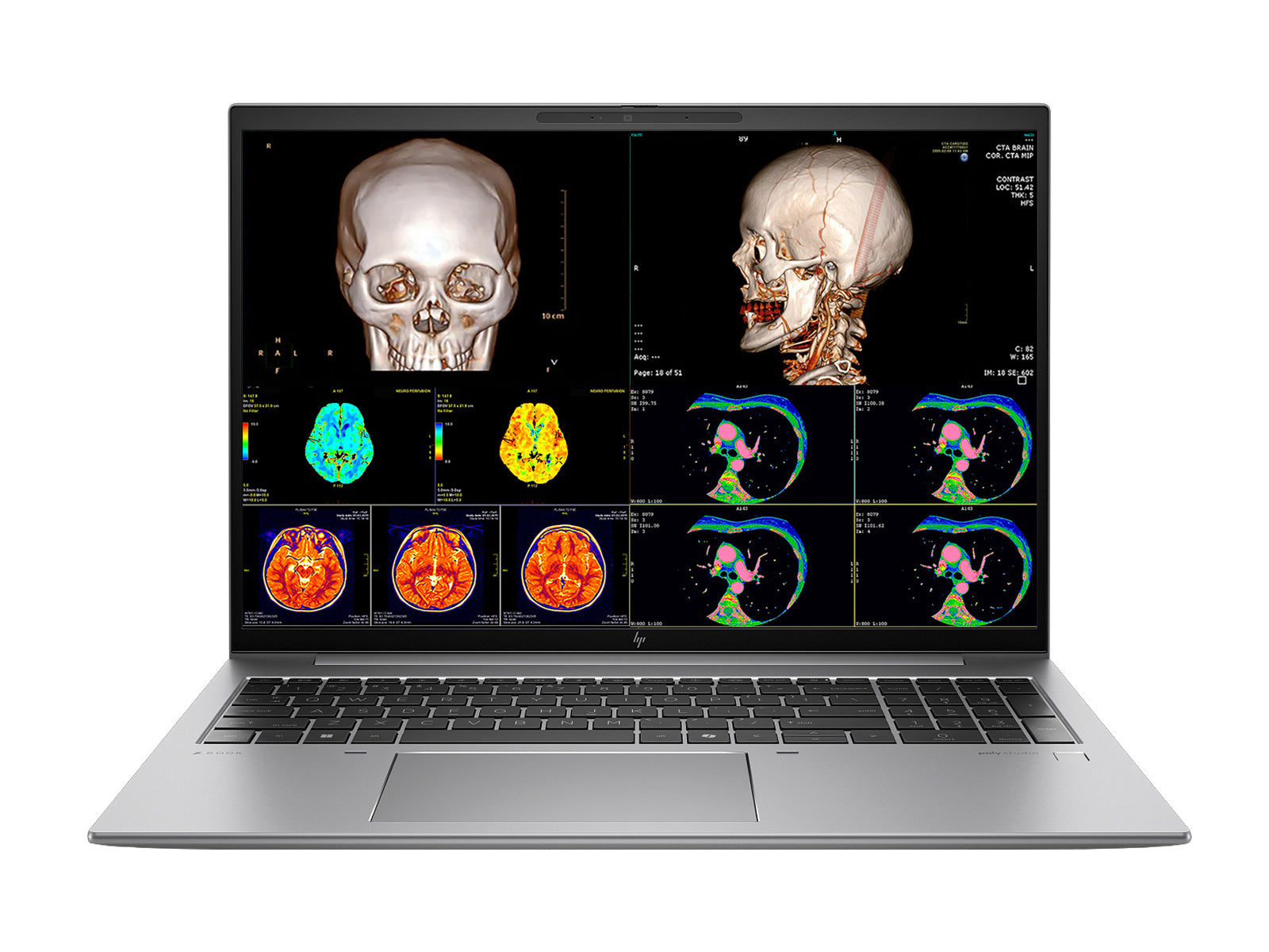 HP Zbook Firefly 16 G11 Estação de Trabalho Móvel de Radiologia | 16" WUXGA Calibrada DICOM | Intel Core Ultra 7 165H @ 5.0GHz | 16 núcleos | 32GB DDR5 | SSD NVMe de 512TB | Intel Arc Graphics 4GB | WiFi 6E