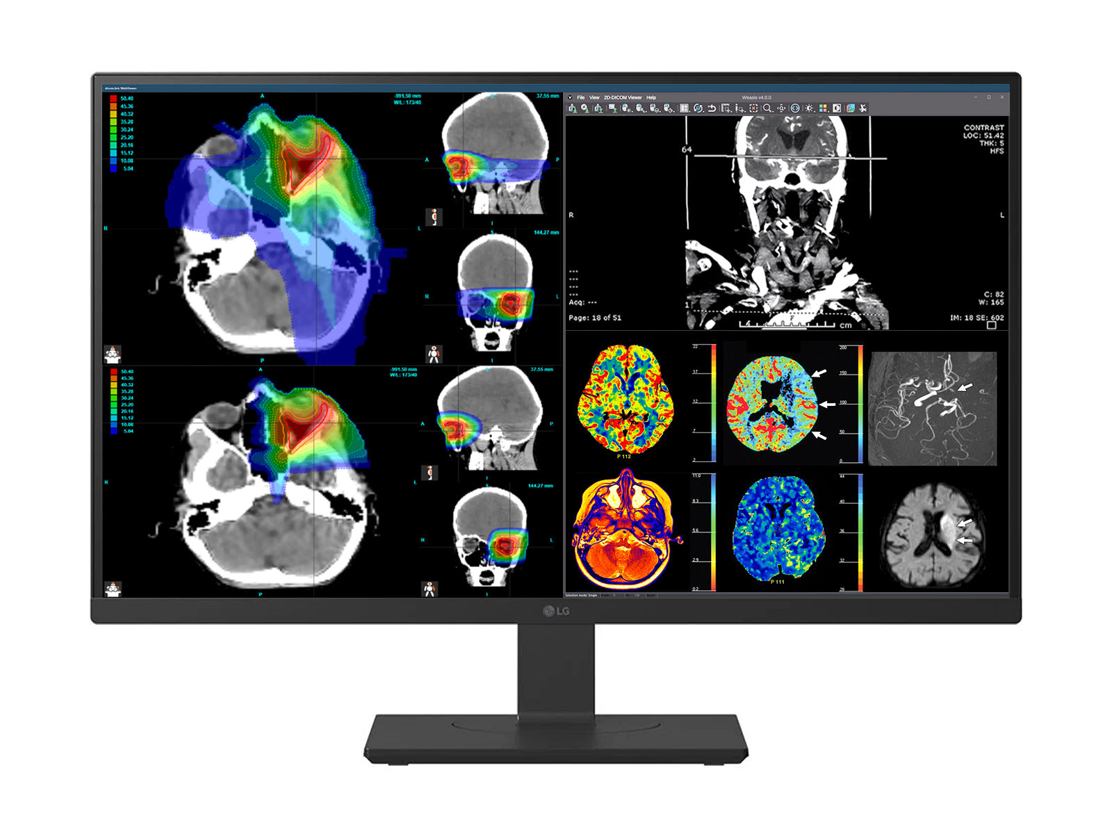 Complete PACS General Radiology Station | Dual LG 27" Color Fusion 8MP 4K | Lenovo ThinkStation P3 Tiny Workstation | Dictation Mic | Worklist Monitor (D27HS713CP3T)