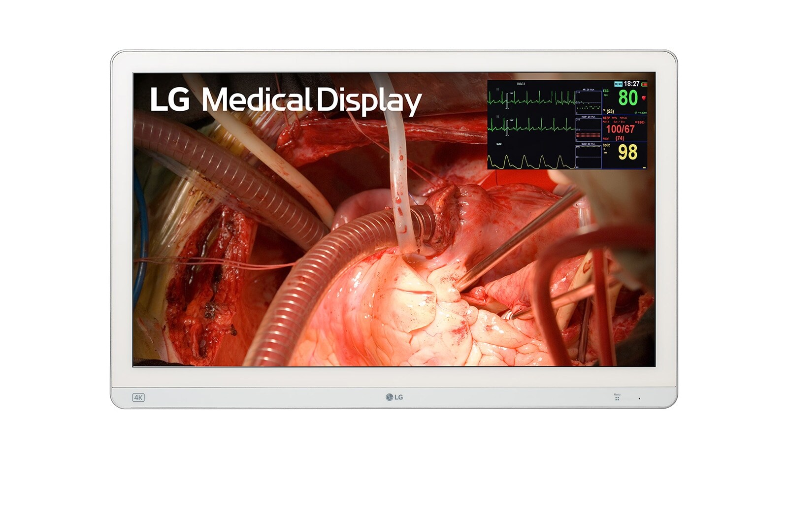 LG 27" 4K Moniteur médical d'endoscopie chirurgicale Mini-LED 3G SDI (27HQ710S-W)