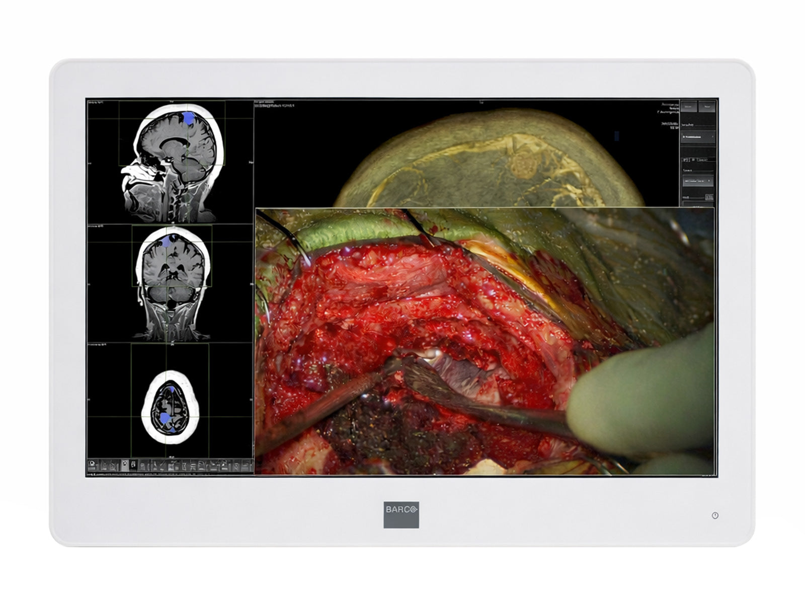 Barco MDSC-2224 MNA 24" 2MP FHD 1920 x 1200 Surgical Endoscopy Medical Display Monitor (K9307913)