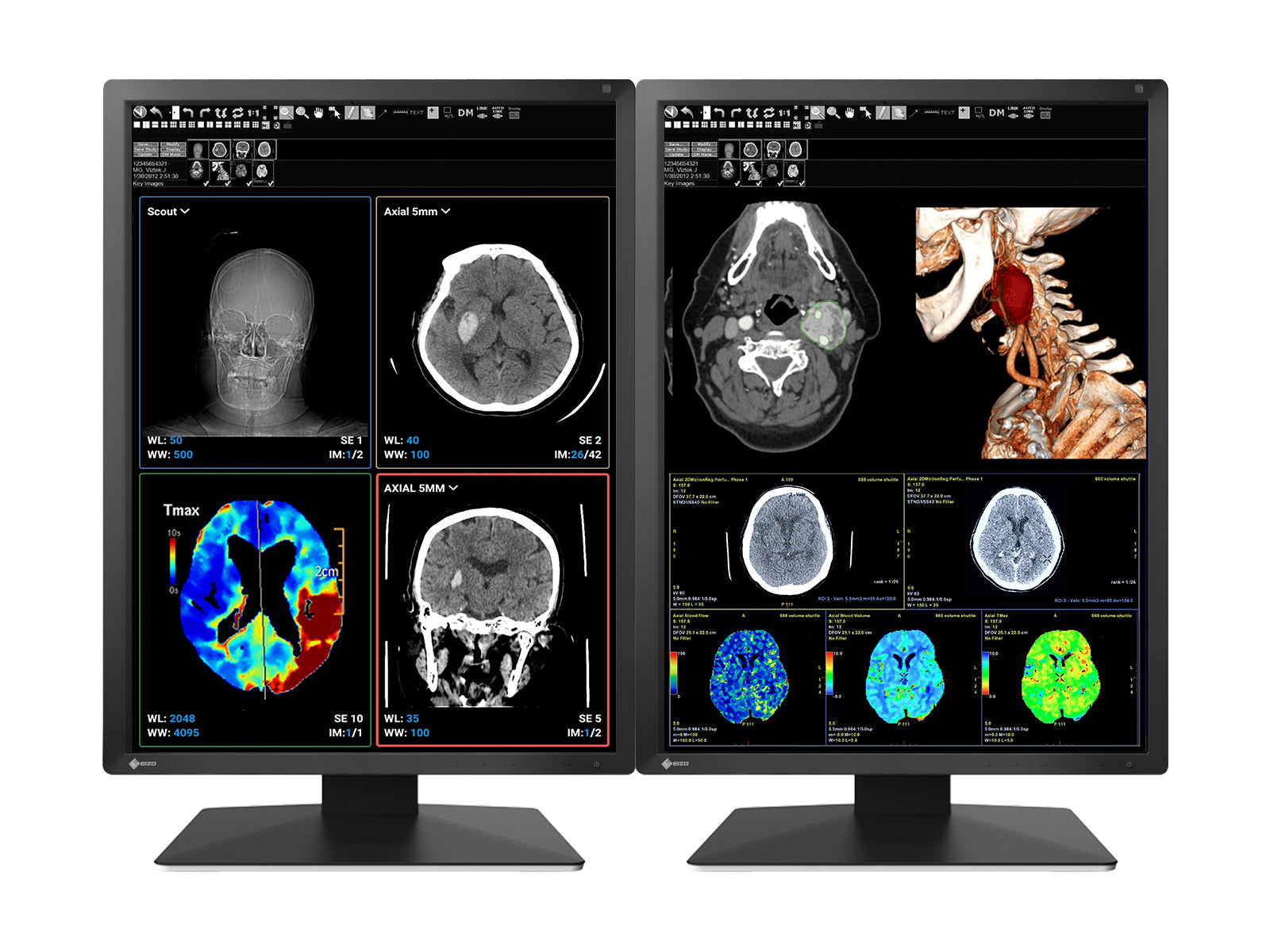 Monitor médico con pantalla LED en color dual Eizo RadiForce MX217 de 2 MP y 21 "(MX217-BK)