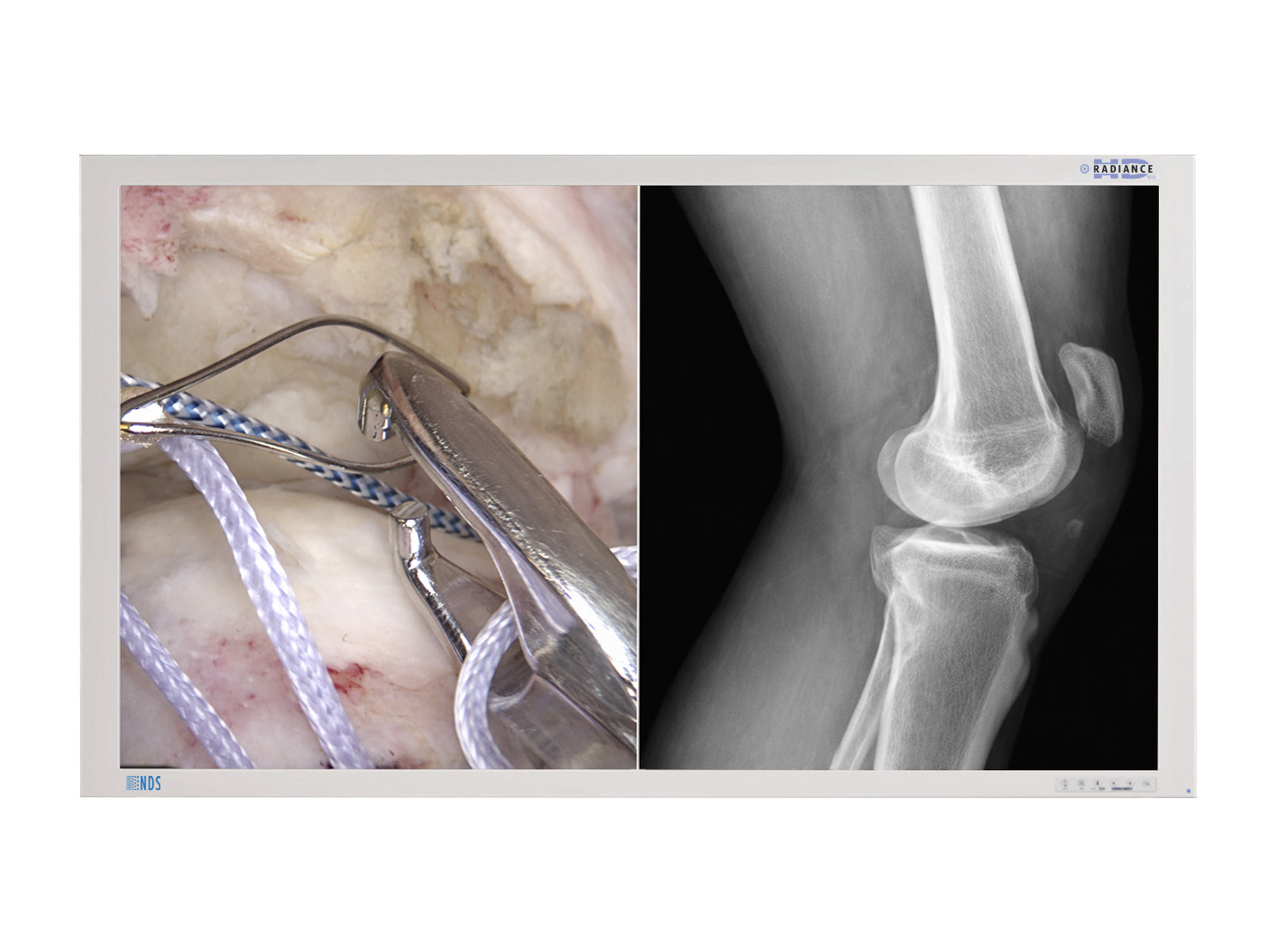 NDS Radiance G2 90R0069 55" SC-WU55-A1A15  FHD LED Surgical Endoscopy Medical Display Monitor