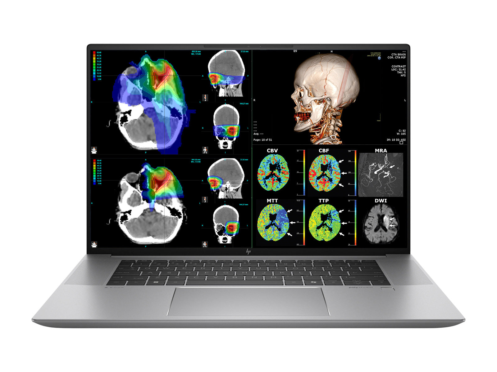 HP ZBook Studio 16 G11 Mobile Radiology Workstation | 16" 9MP 4K+ UHD DICOM Calibrated | Intel Core Ultra 7 155H @ 4.8GHz | 16-core | 64GB DDR5 | 1TB NVMe SSD | RTX 1000 Ada 6GB | WiFi 6E
