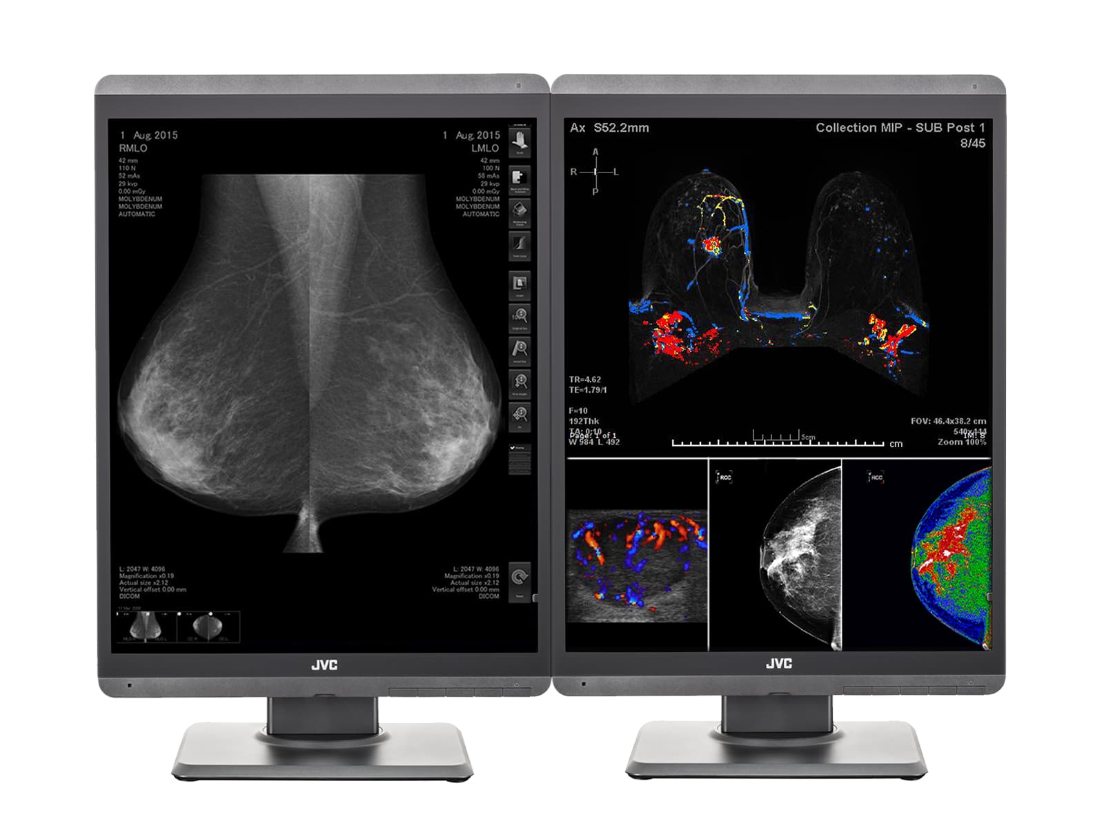 Estación completa de lectura de mamografías | Pantallas JVC Totoku 3D-DBT | Estación de trabajo HP (S500Z6N) Monitors.com