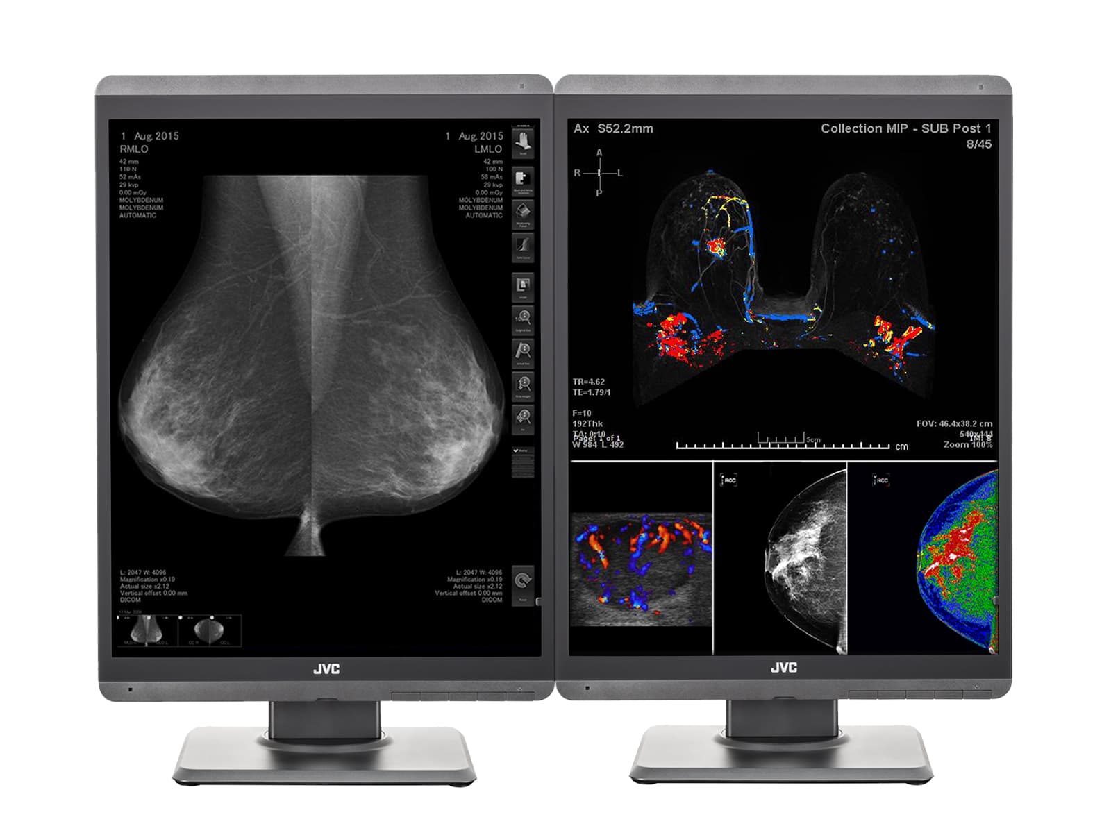 Complete Mammography Reading Station | JVC Totoku 5MP Color 3D-DBT Displays | HP Z4 G5 Workstation | Dictation Mic | Worklist Monitors (S500Z4G5)