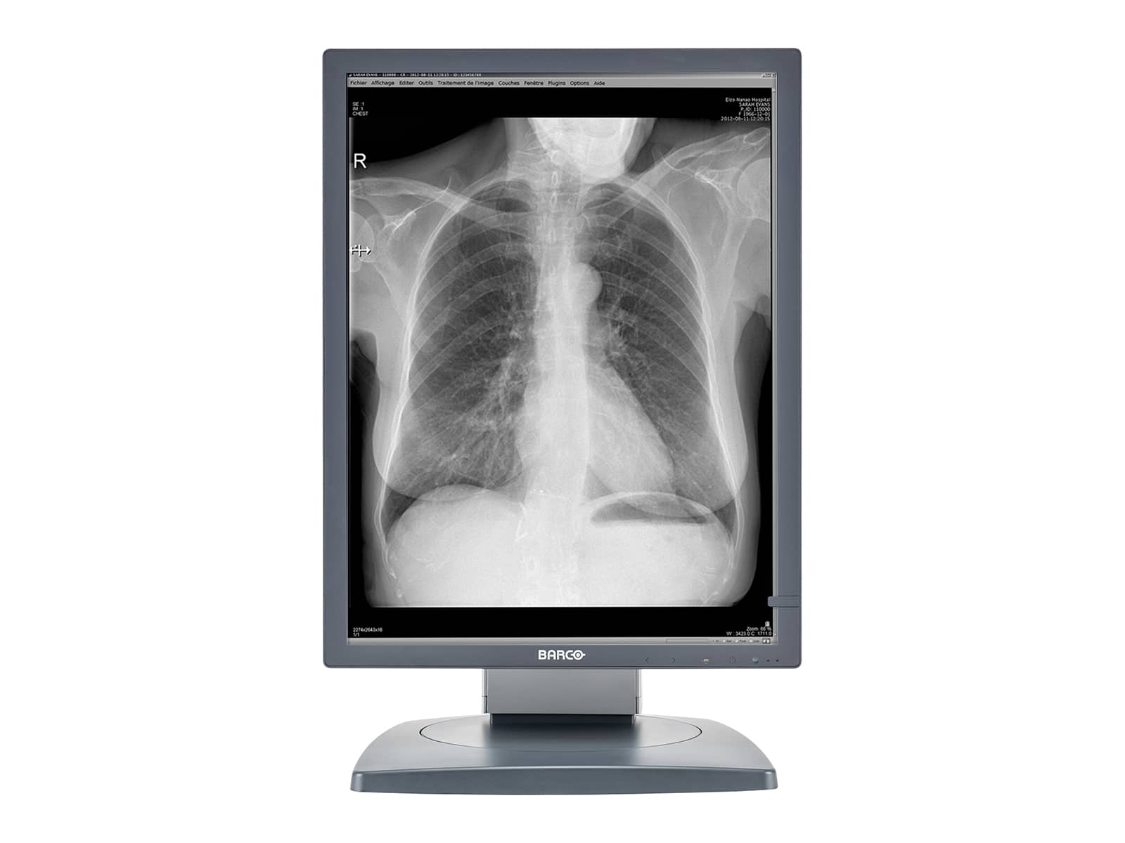 Barco Coronis MDCG-3120 3MP 21" Graustufen-Diagnosedisplay für allgemeine Radiologie (K9601662) Monitors.com