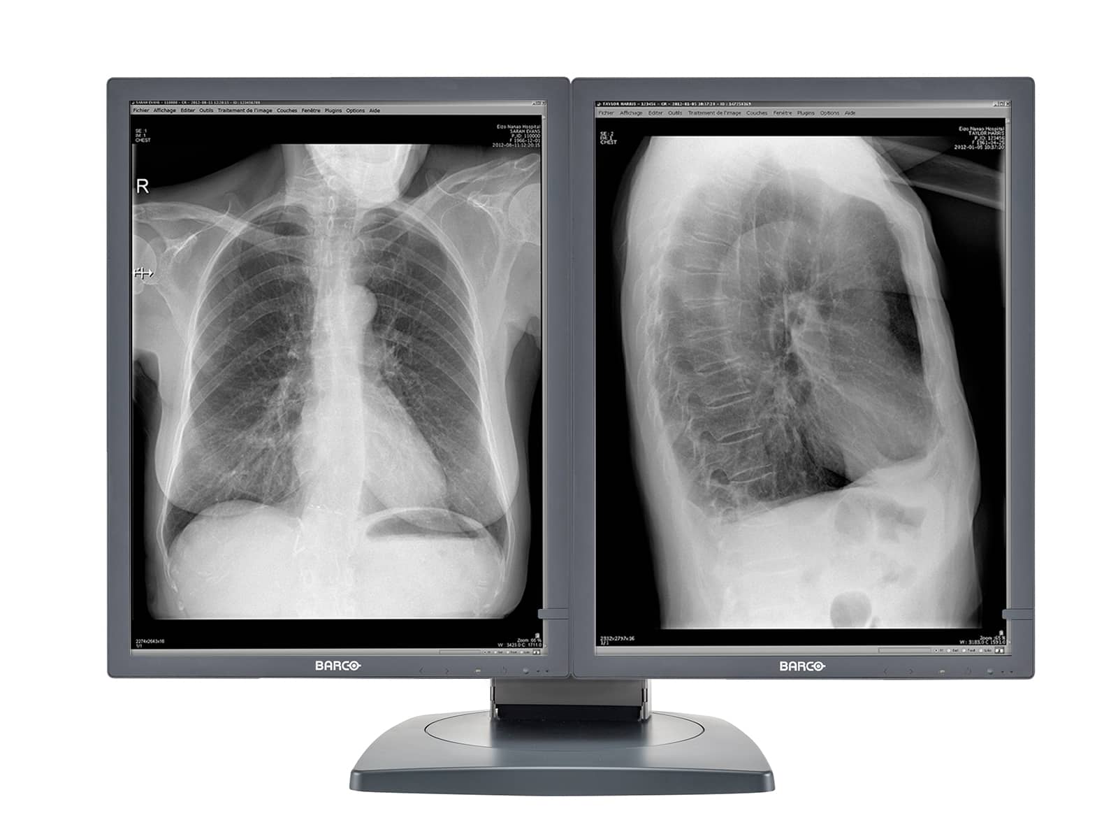 Barco Coronis MDCG-2121 2MP 21" Grayscale Diagnostic Radiology PACS Monitor