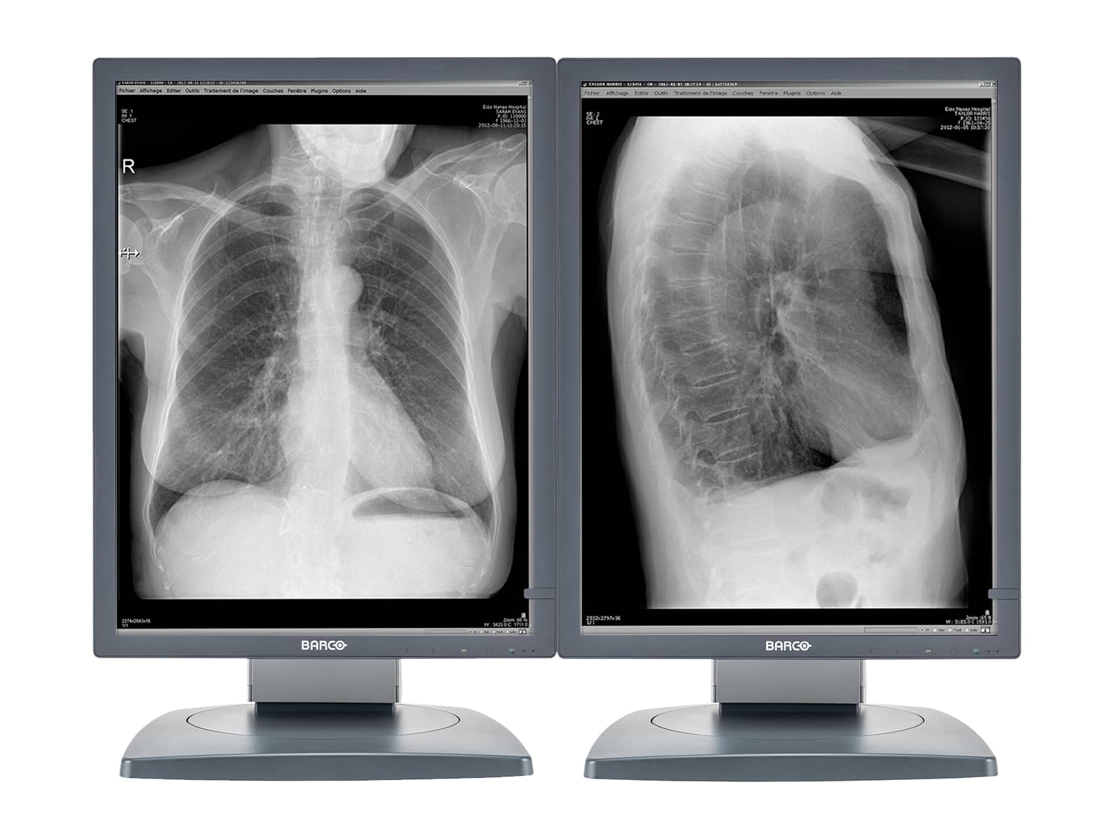 Barco Coronis MDCG-3120 3MP 20.8" Grayscale General Radiology Diagnostic Display