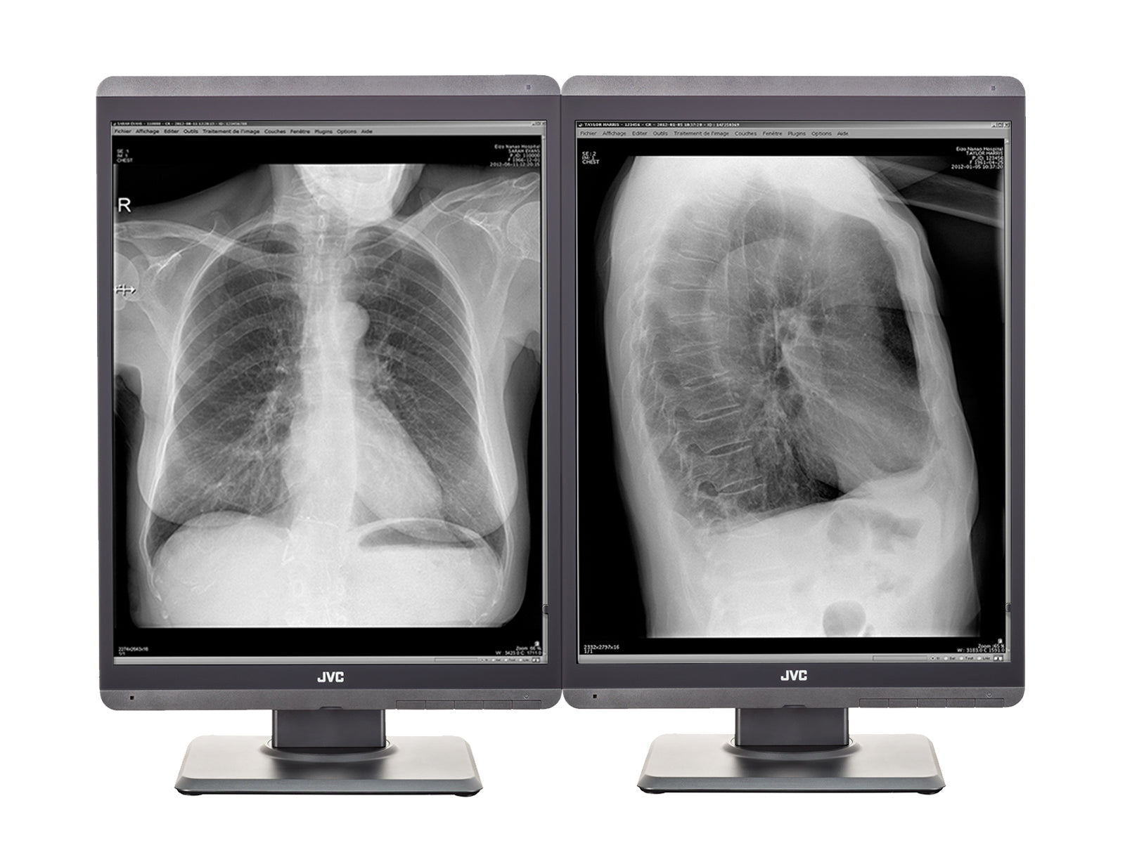 JVC Totoku MS-S200 2MP 21" Grayscale Diagnostic Radiology Display Monitor (MS-S200)