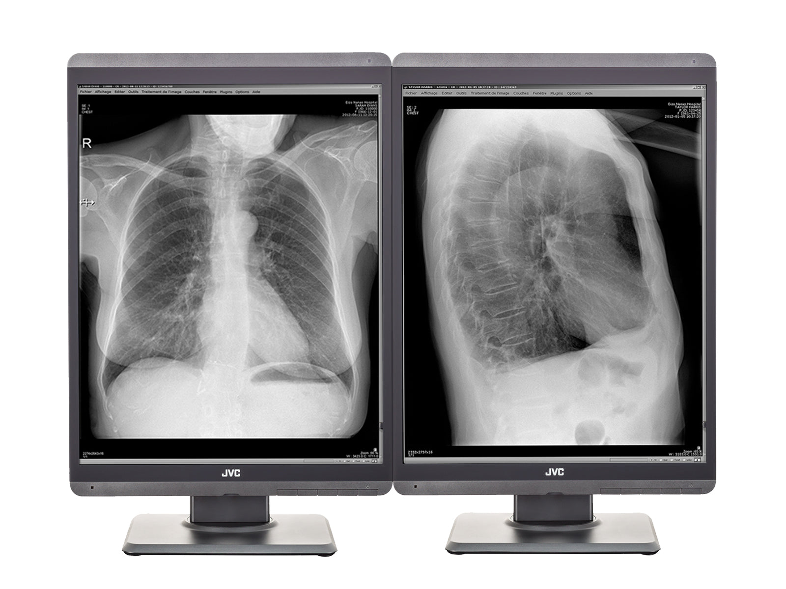 Moniteur d'affichage de radiologie diagnostique en niveaux de gris JVC Totoku MS-S200 2MP 21" (MS-S200) Monitors.com