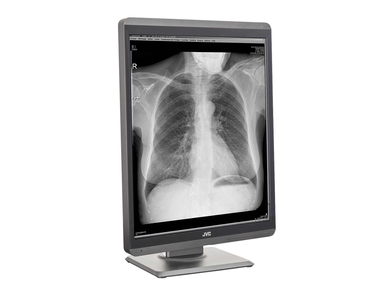 JVC Totoku MS-S200 2MP 21" Grayscale Diagnostic Radiology Display Monitor (MS-S200)