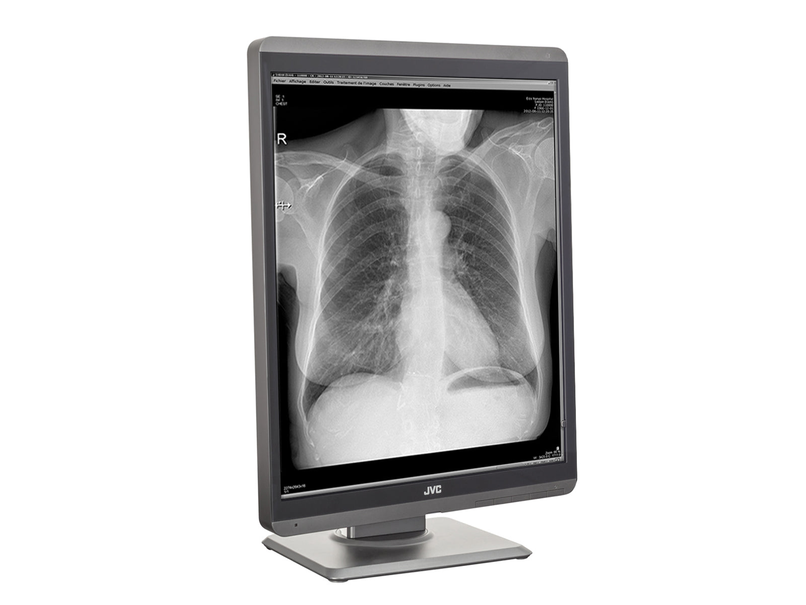JVC Totoku MS-S200 2MP 21" Graustufen-Diagnose-Radiologie-Display-Monitor (MS-S200) Monitors.com
