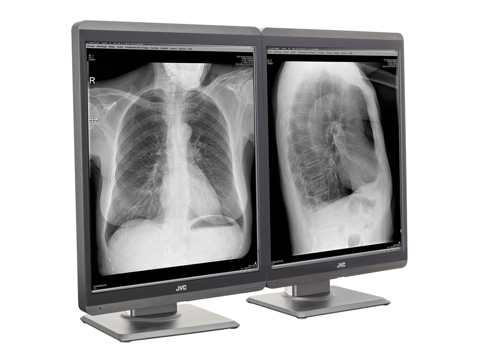 JVC Totoku MS-S300 3MP 21" LED-Graustufen-Diagnosemonitor für allgemeine Radiologie (MS-S300)