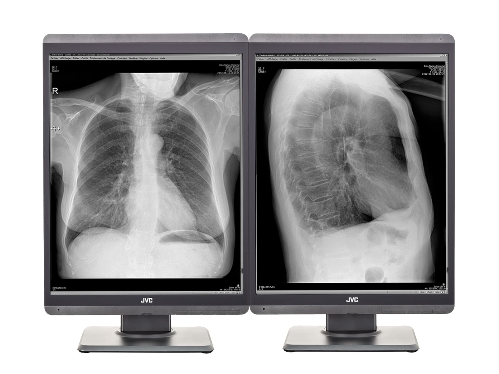 JVC Totoku MS-S300 3MP 21" LED Monitor de pantalla de diagnóstico de radiología general en escala de grises (MS-S300)