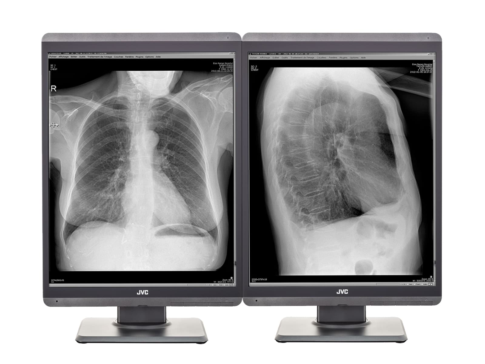 JVC Totoku MS-S300 3MP 21" Moniteur d'affichage de diagnostic de radiologie générale LED en niveaux de gris (MS-S300)