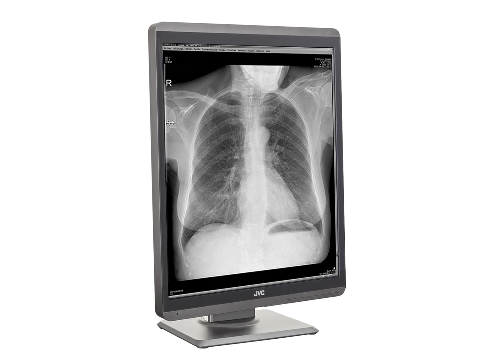 JVC Totoku MS-S300 3MP 21" LED-Graustufen-Diagnosemonitor für allgemeine Radiologie (MS-S300)